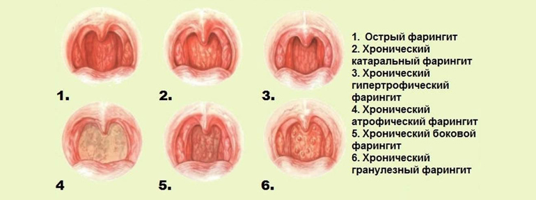 виды фарингита