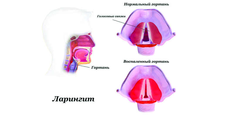Как проявляется ларингит
