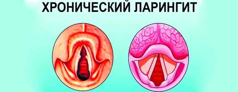 Что такое хронический ларингит