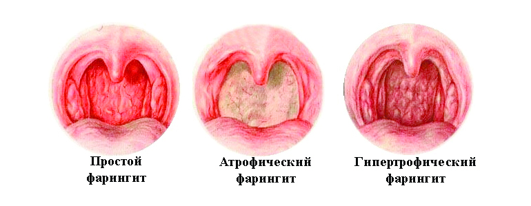 Виды ларингита