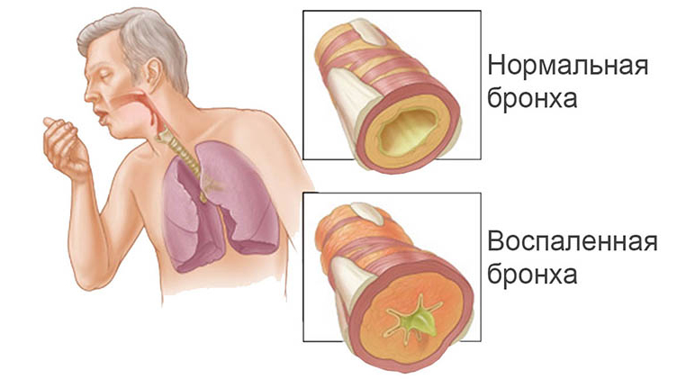Причины боли в горле по утрам