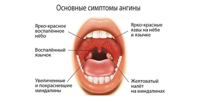 Признаки ангины