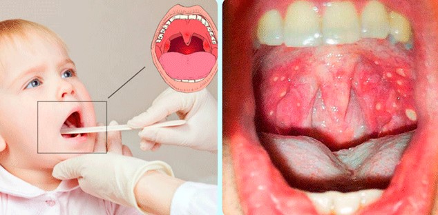 герпангина у детей