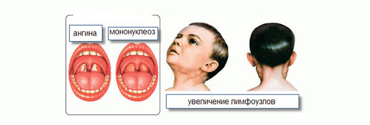 ангина и мононуклеоз