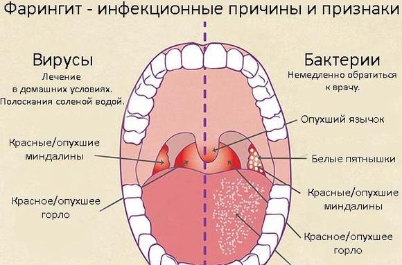 фарингит