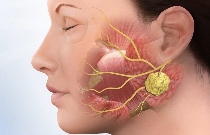 Симптомы паратонзиллярного абсцесса