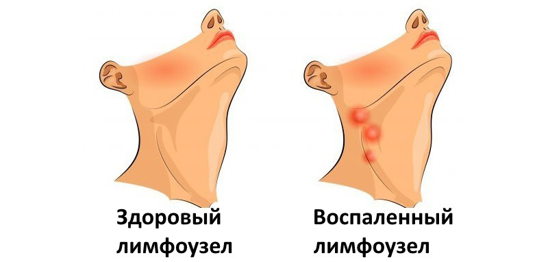 Почему воспаляются лимфаузлы