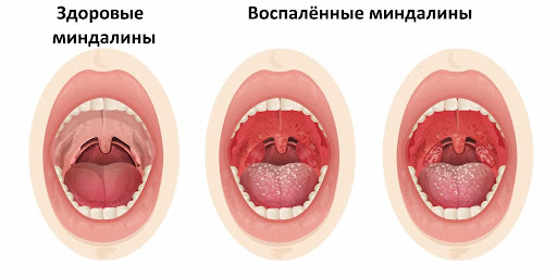 воспаленные миндалины
